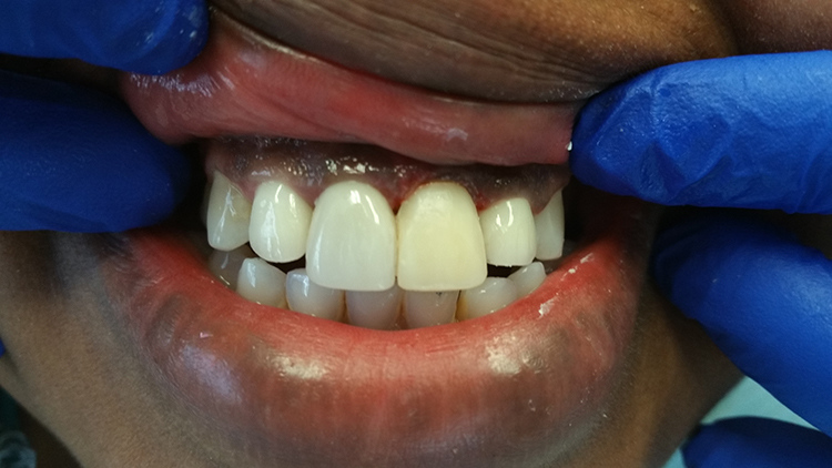 CASE_7_FRONT_TOOTH_WITH_TEMPORARY_CROWN_SAME_DAY.jpg